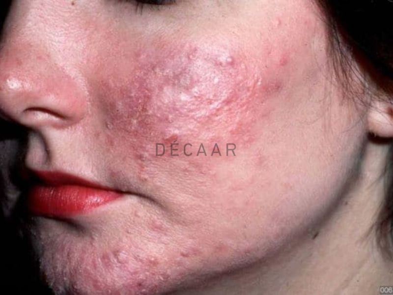 kem trị mụn trứng cá đỏ
